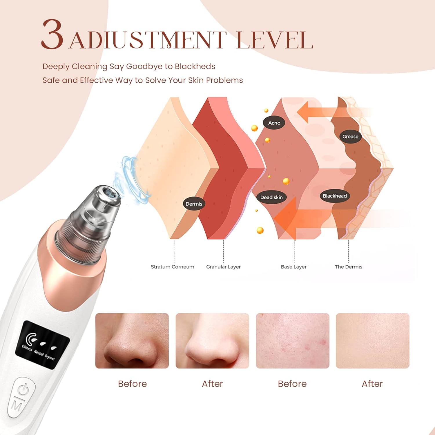 Newest Technology Blackhead Re - مراجعة Luxury Skincare Acne وسعره