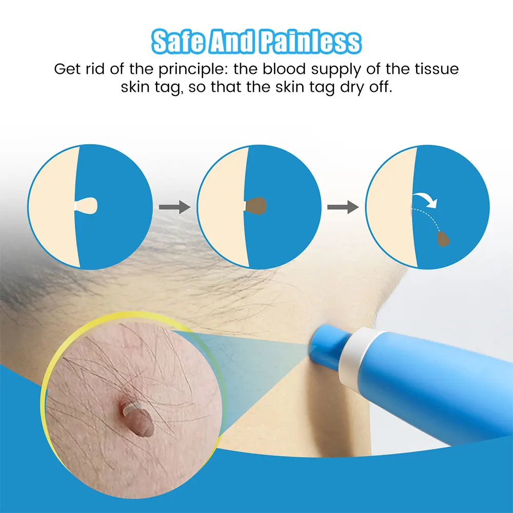 Auto Skin Tag Removal Tool Kit - مراجعة Luxury Skincare Acne وسعره
