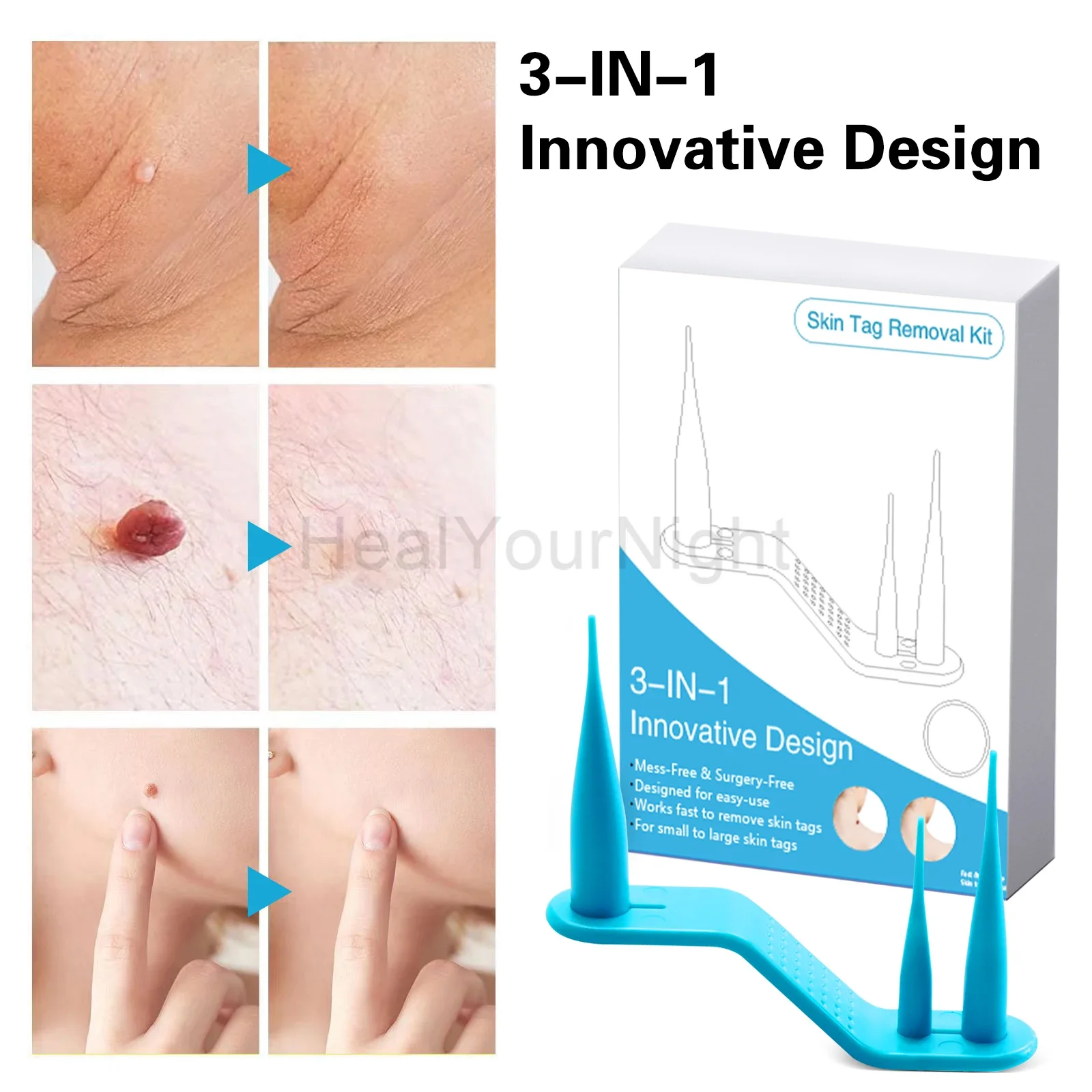 IDEABEL 3-IN-1 Auto Skin Tag R - مراجعة Luxury Skincare Acne وسعره